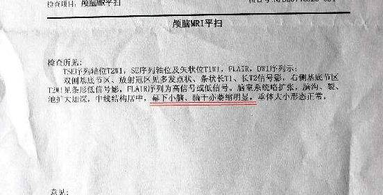 原创ct磁共振报告上的脑萎缩是什么或是3种疾病引起要留心