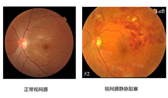 视网膜静脉迂曲扩张,视网膜内出血,视网膜水肿和黄斑水肿.