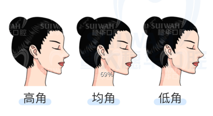 高角面型:脸长,常伴有下巴后缩,适合拔牙.