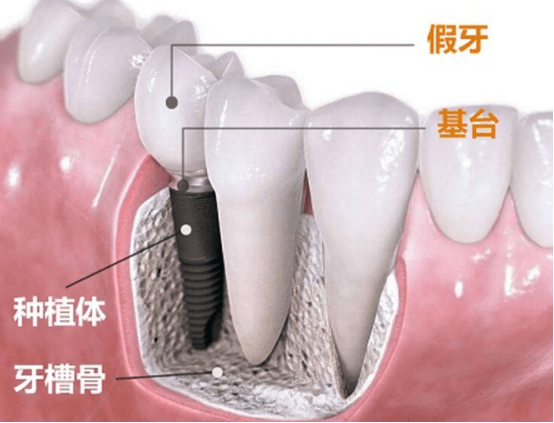 一开始在骨头中是机械固定,然后三个月变成骨结合