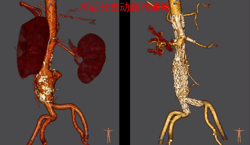 经过3个月的综合治疗,复查cta动脉瘤萎缩且气泡影消失,支架无感染