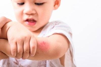 痒痒痒！孩子被蚊虫叮咬后,这样止痒最有效！