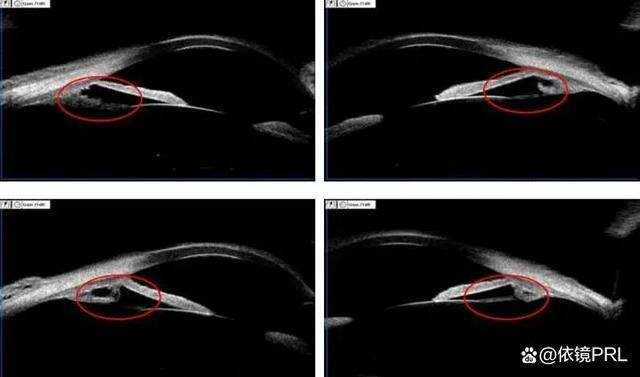 左眼ubm四图根据以上四图,我们明显可以看到以上三个象限睫状突非常小
