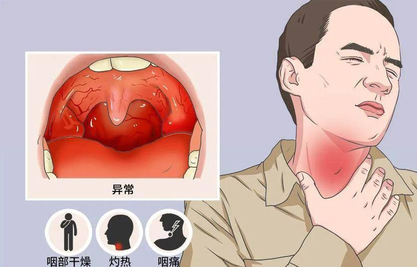 咽喉炎频繁发作或与这4个原因有关