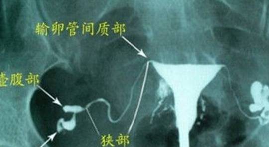 原创输卵管粘连在平时需要注意哪些事项做造影时有哪些显示