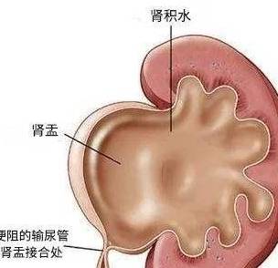 怀孕中期b超检查胎儿双肾系统分离是怎么回事,什么原因?