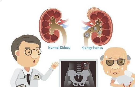 肾结石问题该如何治疗？肾积水、肾衰退严重吗？