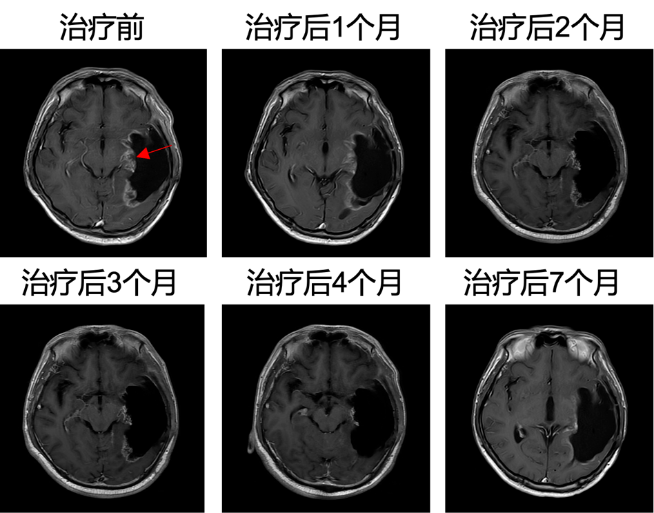 招募|新型溶瘤病毒Ad-TD-nsIL12治疗弥漫内生性脑桥胶质瘤的研究