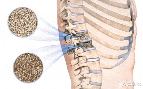 58岁白叟夜里骨折，悄悄离世。医生：那1食物天天吃，骨骼或如“蜂窝”