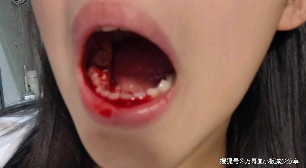 梦境解析，梦见自己牙齿掉了还流血不止——深层心理与健康预警的信号