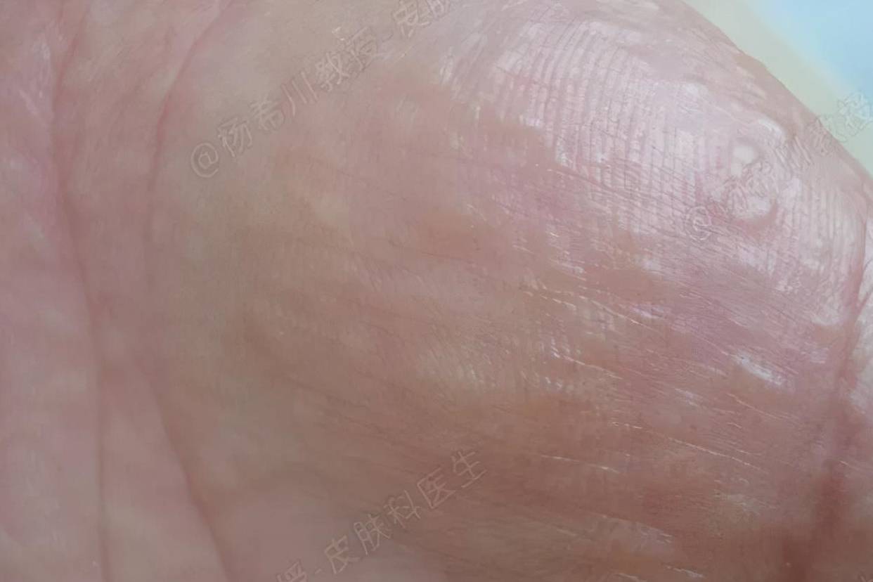 手上奇痒无比的“水泡”，是怎么回事？汗疱疹应该如何预防？