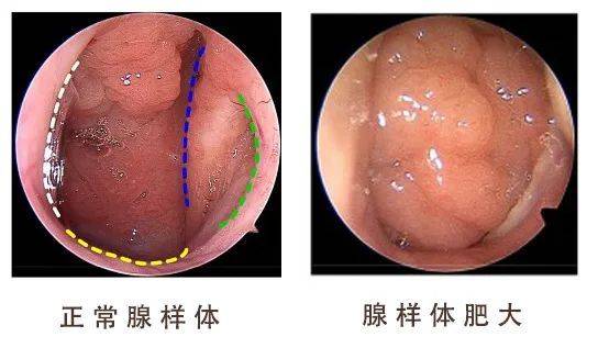 霍思燕晒儿子近照，9岁嗯哼被质疑“长残”，这是腺样体面容？