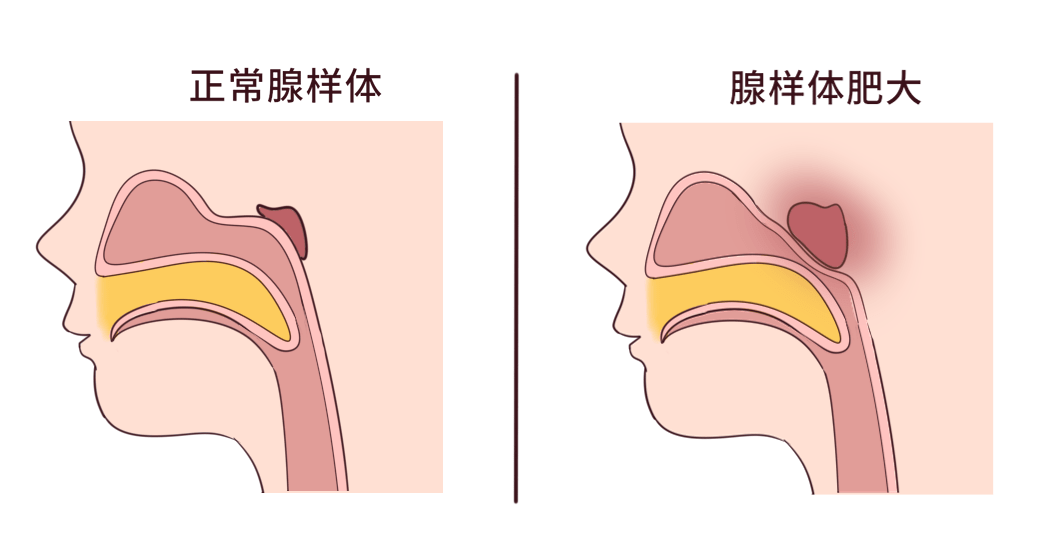 嗯哼被怀疑是腺样体面容 ，霍思燕回应：医生说不是!