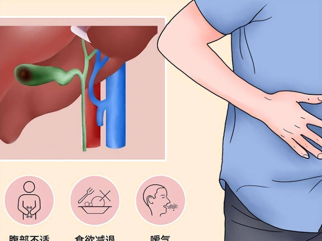 治疗急性胆囊炎首选替代治疗方法，经皮胆囊造瘘术疗效怎么样？