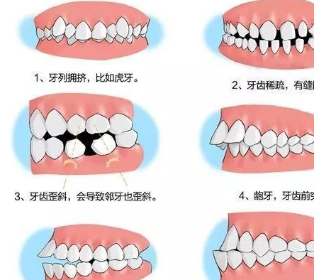 牙齿矫正需要多长时间？哪些因素会影响牙齿矫正时间长短？