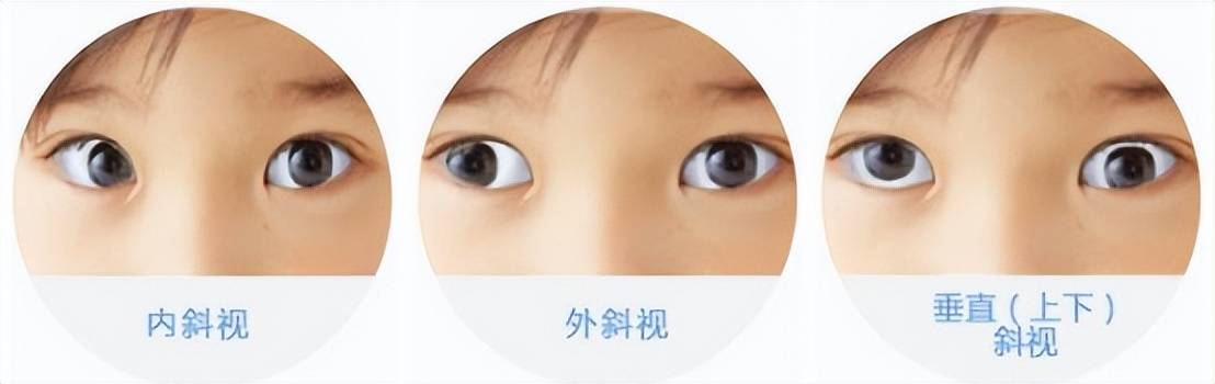 南石眼科丨改”斜“归正，带您了解斜视手术