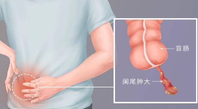 ，阑尾虽小，作用不小。它犹如一位低调的卫士，默默守护着我们的健康。