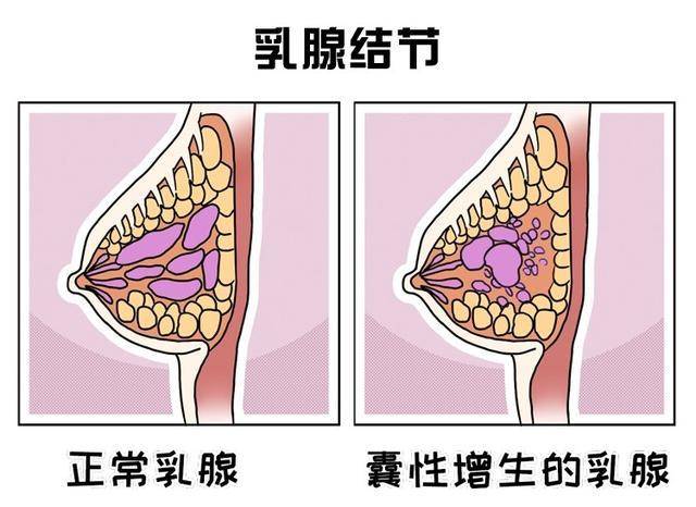 成都普济中医药研究院黄宏：乳腺结节怎么吃？饮食注意有哪些？