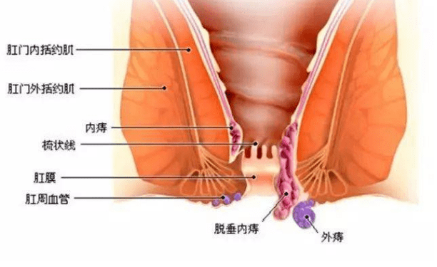 痔疮的饮食该注意什么呢？