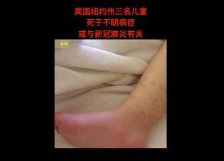 「变异」疑似新冠并发症！孩子开学在即，我们该如何防范？病毒或已变异？14岁以下孩子“怪病”频发