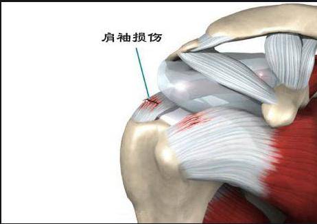 物理疗法配合运动康复治疗急性肩袖损伤的 临床疗效评价
