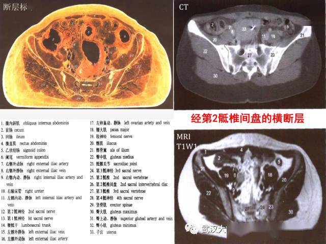 女性盆腔解剖与断层影像