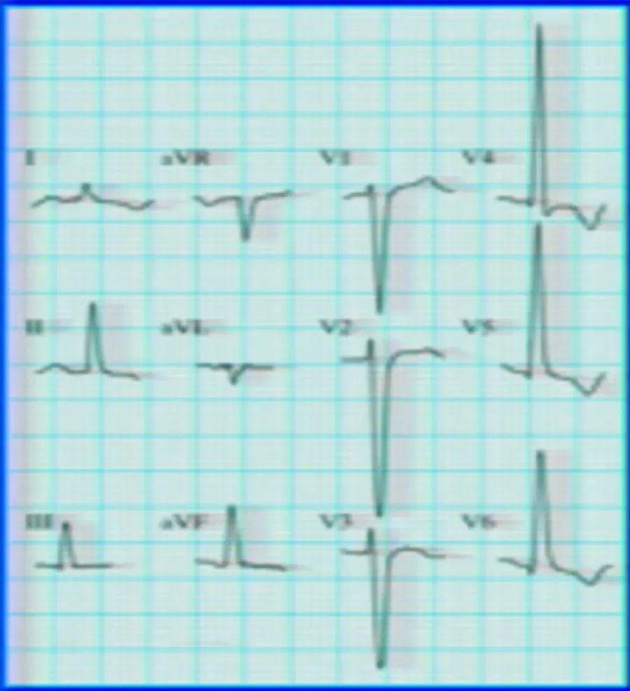 例dcm病例的心电图可见左束支传导阻滞,左房增大,v1~v4导联病理性q波