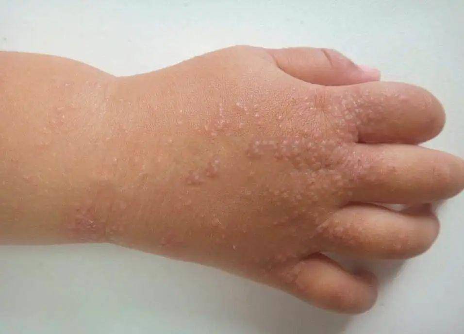 14 种临床形似「湿疹」和「皮炎」的儿童皮肤病,希望对提高大家的鉴别