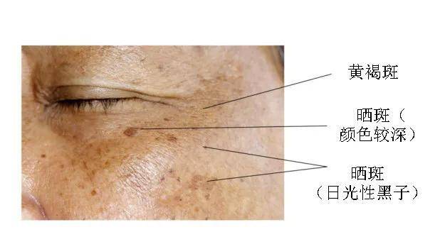 同时,在不注意防晒的患者,  面部常常可以同时出现黄褐斑及日光性雀斑