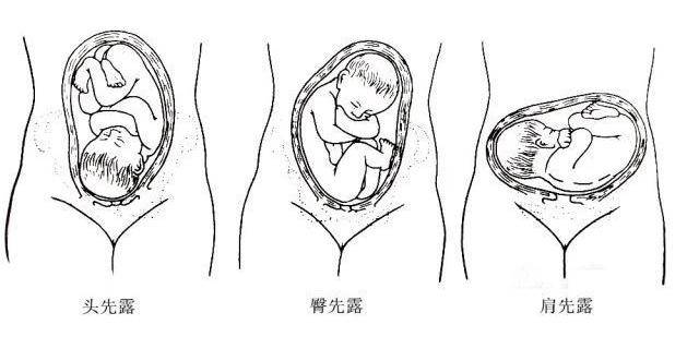 1,头盆不称,胎头入盆困难(可通过医生检查明确); 2,胎位异常,如臀先露