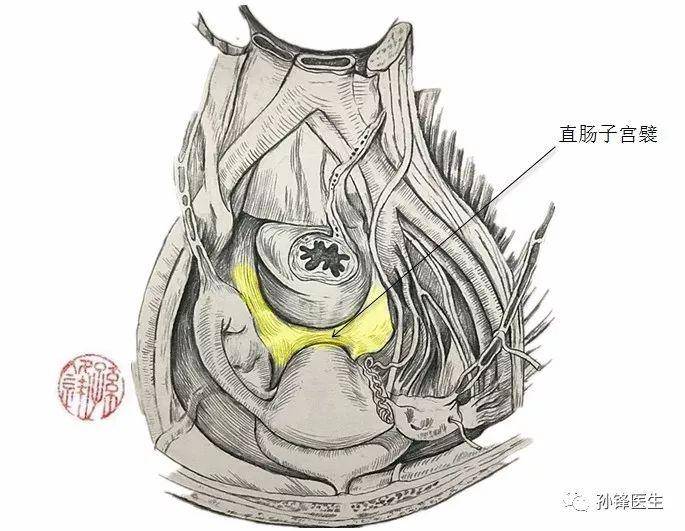 清楚了直肠和子宫之后,我们发现,在女性膀胱和子宫之间有膀胱子宫陷凹
