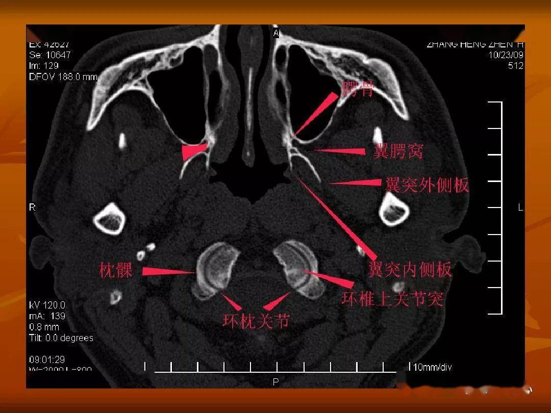 颅骨外伤性骨折ct诊断