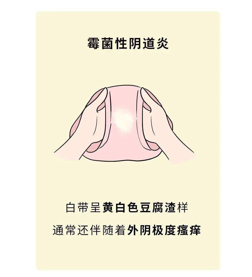 霉菌性阴道炎就会主动上门潮湿的环境很容易滋生霉菌内裤还没晒干就