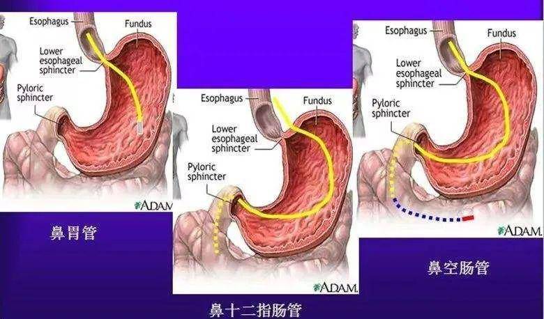 【技术业务】重症医学科成功完成首例鼻肠管置入术