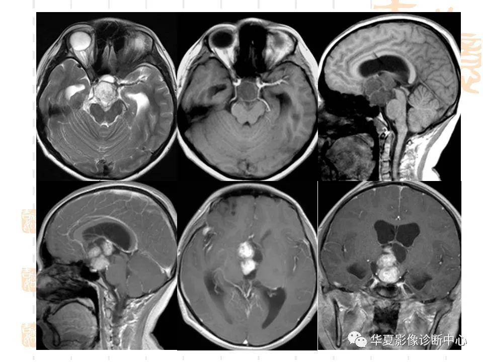 侵袭性垂体瘤的mri 征象