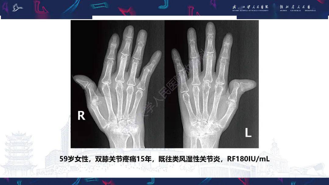 关节痛风影像诊断