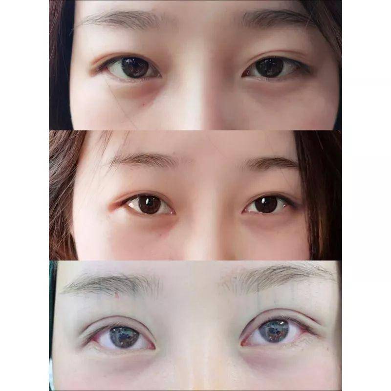 如何拥有双眼皮大眼睛 17ea5fcaa2da44d5bbe749236aa7b579.jpeg