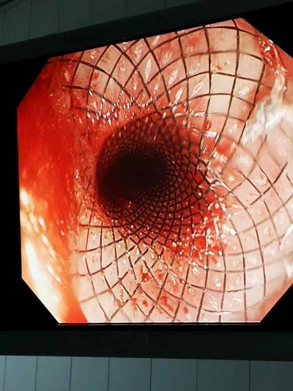 创新我院消化内科成功完成又一例内镜下食道支架置入术