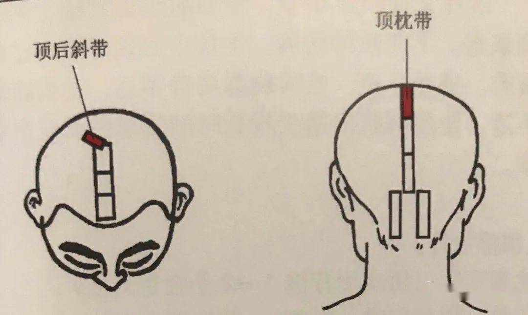 顶枕带顶后斜带头部刮痧宜白天进行,刮拭时可不涂抹刮痧油,刮痧时应