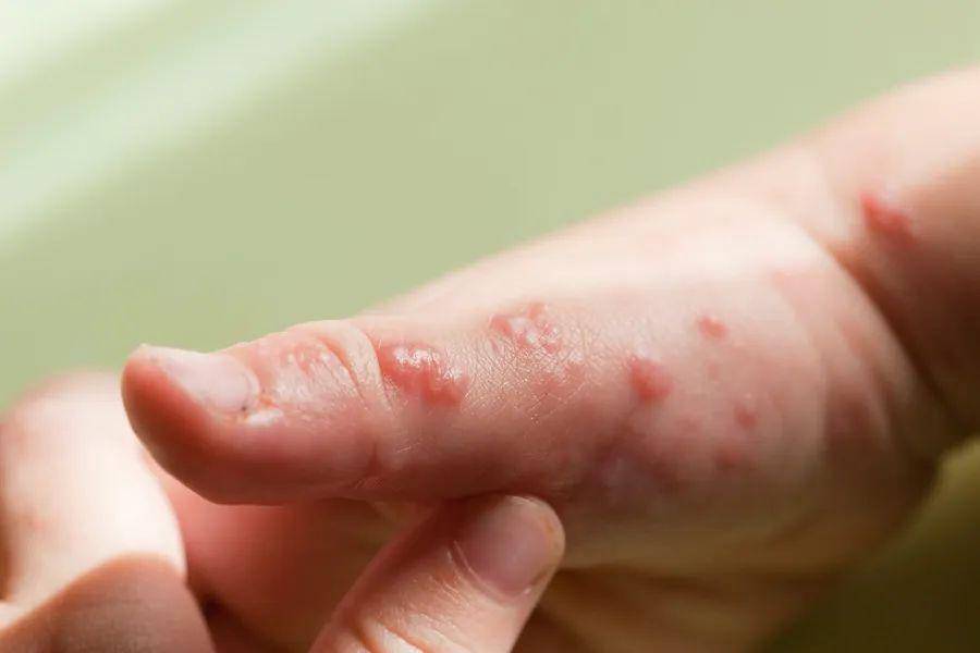 亚急性湿疹:同样会痒,以小丘疹,鳞屑,结痂为主,少有丘疱疹,水疱和糜烂