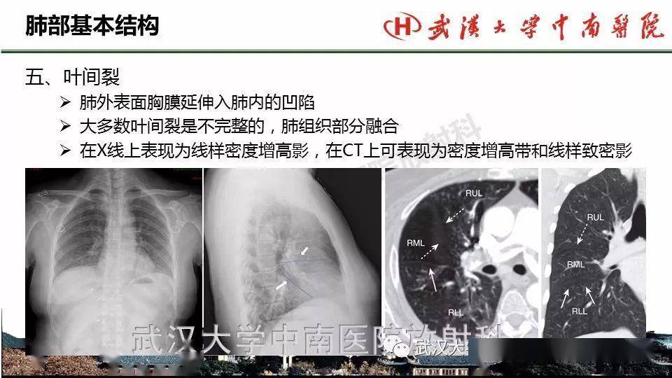 肺部影像解剖及基本概念,基本病变