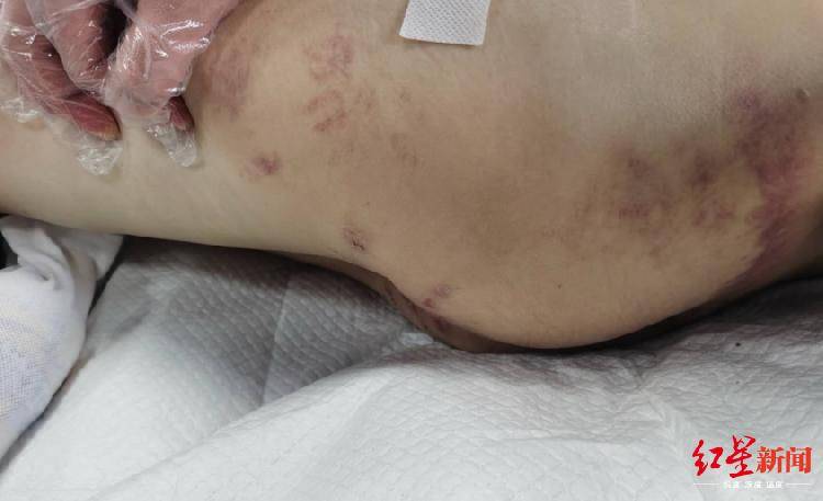 恒耀平台注册山西怀仁12岁女童疑遭继母虐待致脑梗死,检方提前介入 (图3) 恒耀平台注册山西怀仁12岁女童疑遭继母虐待致脑梗死,检方提前介入 (图3)