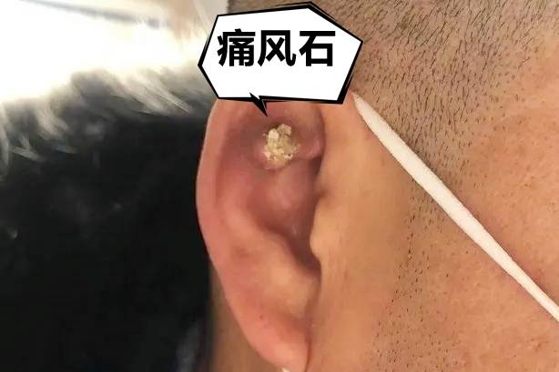 黑松露粉提醒你痛风石会出现在手脚耳朵等地方