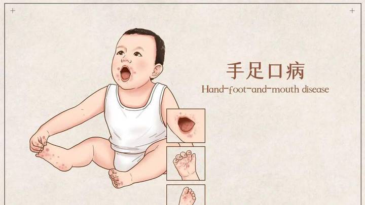 西安一医院日接500多患儿,你有得过疱疹性咽峡炎吗?