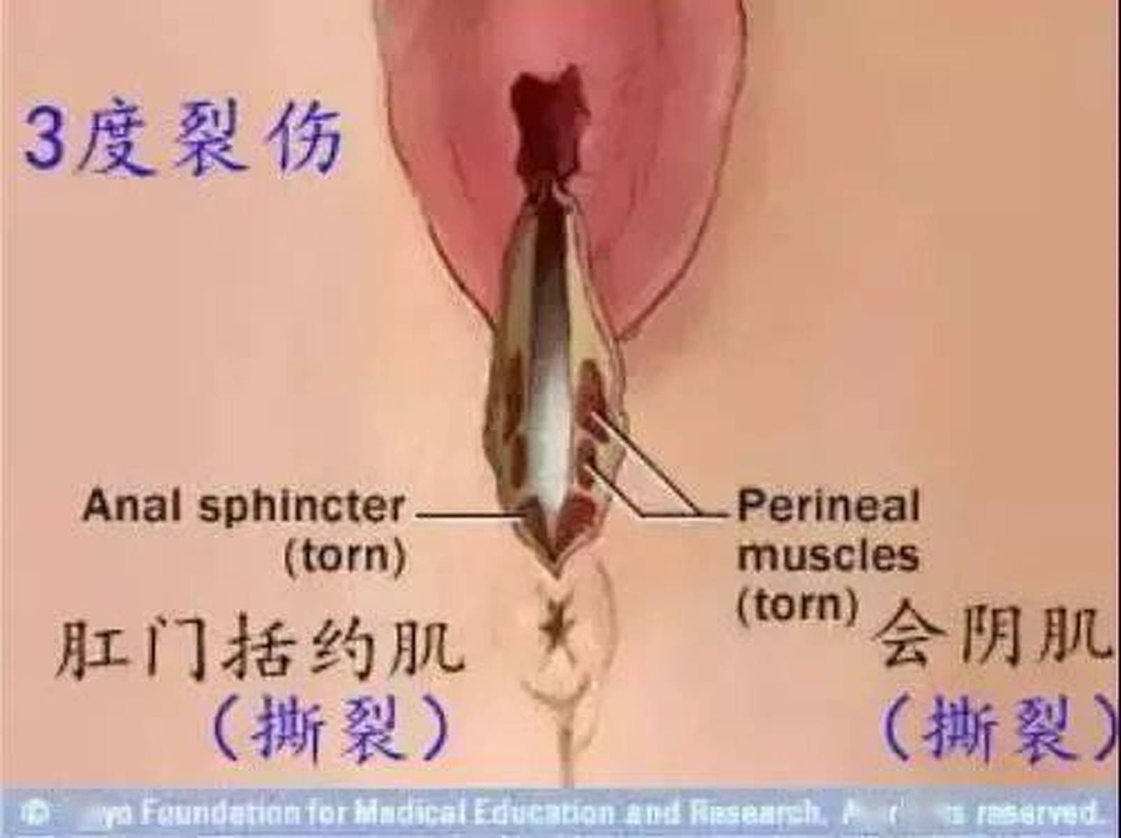 10个顺产，8个阴道撕裂！减轻裂伤的方法，你知道吗？