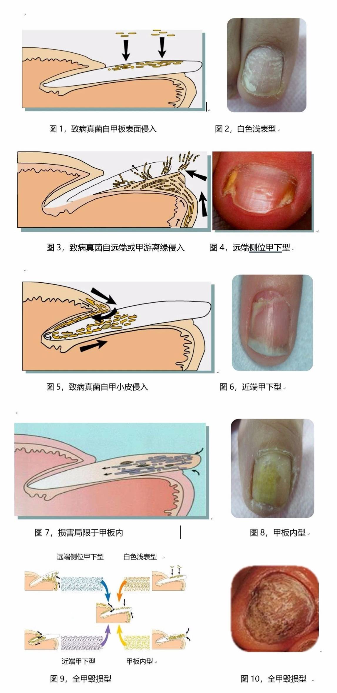 指甲变灰就是灰指甲吗?别像他一样白白花钱了