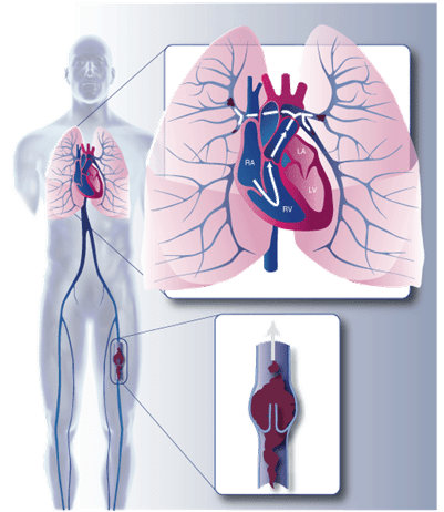 再进入肺动脉并阻塞肺动脉主干或分支,就发生了肺动脉血栓栓塞,简称肺