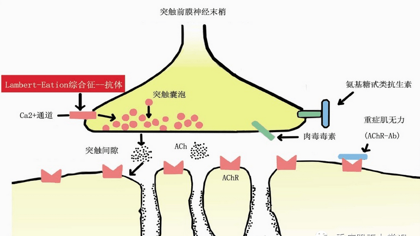 一种自身免疫性疾病,主要是指神经和肌肉接头处的传递功能发生了障碍