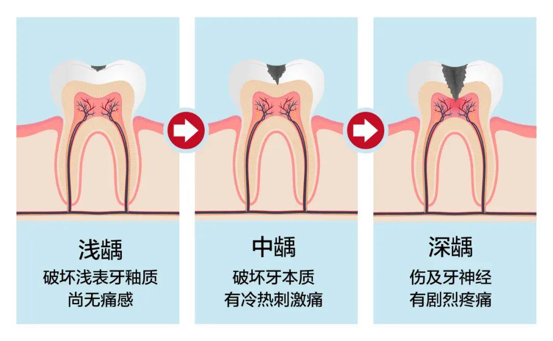 龋齿