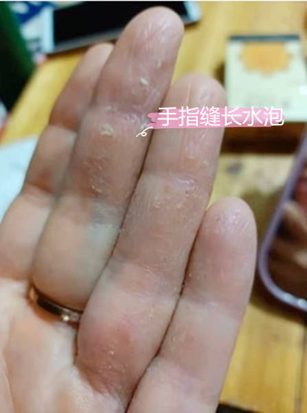 手指缝长水泡是什么?痒还脱皮,医生:多吃些芹菜